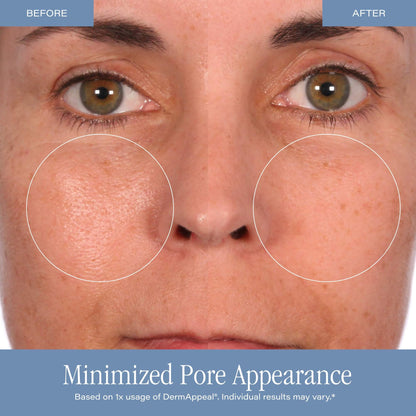 DermAppeal® Microdermabrasion Treatment